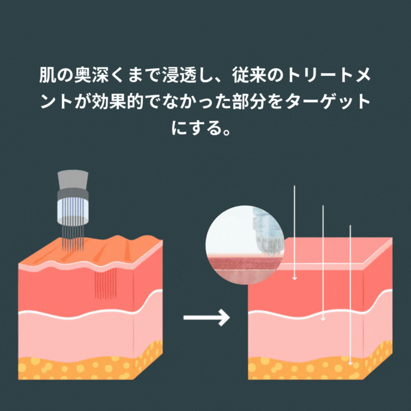 マイクロインフュージョン アンチエイジング キット™